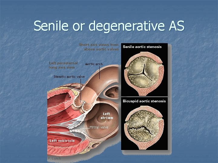 Senile or degenerative AS 