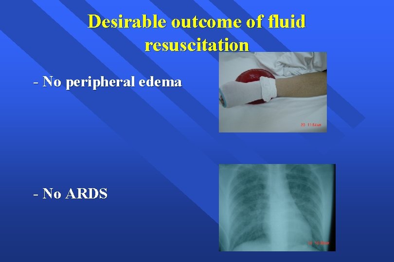 Desirable outcome of fluid resuscitation - No peripheral edema - No ARDS 