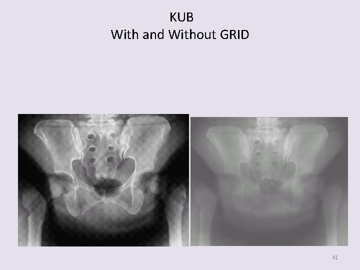 KUB With and Without GRID 41 
