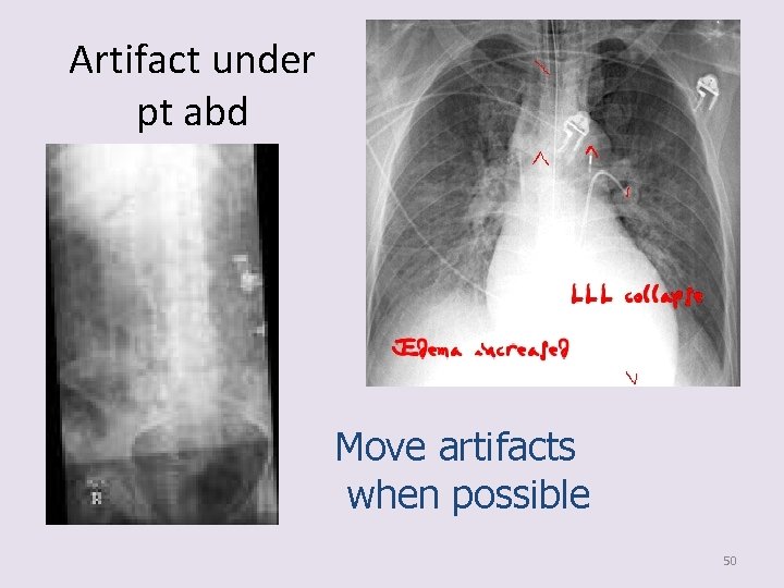 Artifact under pt abd Move artifacts when possible 50 