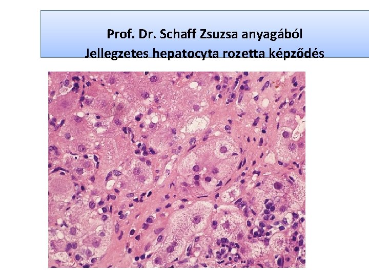 Prof. Dr. Schaff Zsuzsa anyagából Jellegzetes hepatocyta rozetta képződés 