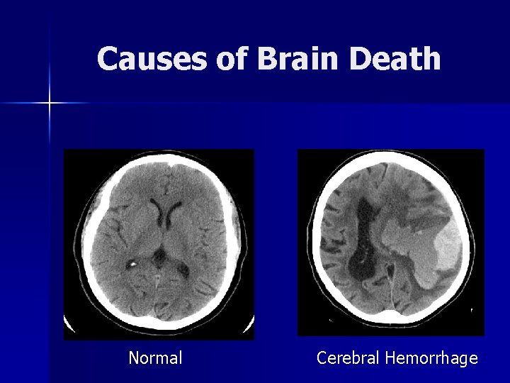 Causes of Brain Death Normal Cerebral Hemorrhage 