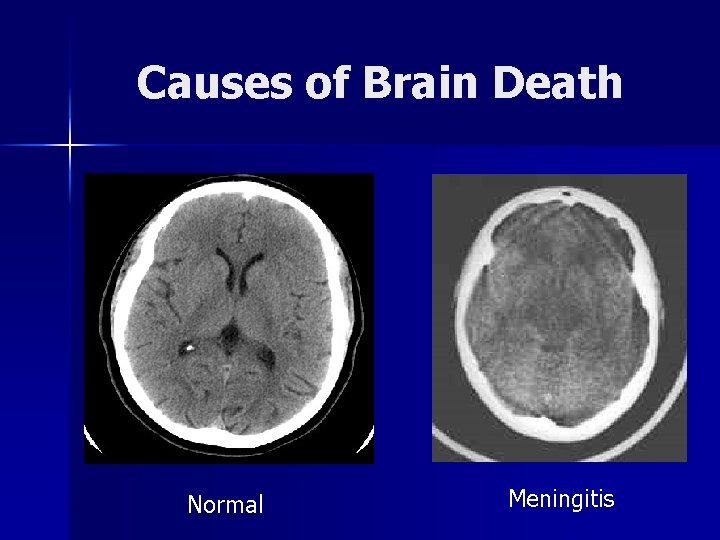Causes of Brain Death Normal Meningitis 