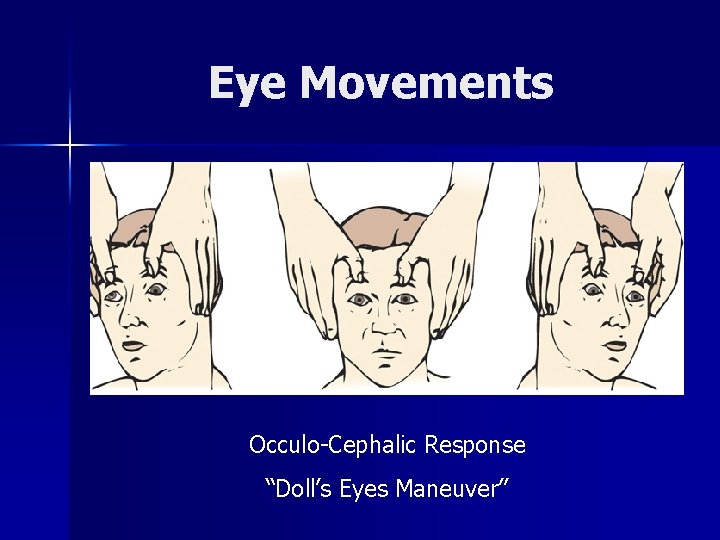 Eye Movements Occulo-Cephalic Response “Doll’s Eyes Maneuver” 