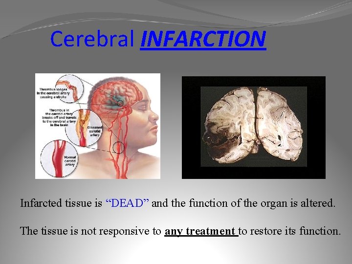 Cerebral INFARCTION Infarcted tissue is “DEAD” and the function of the organ is altered.