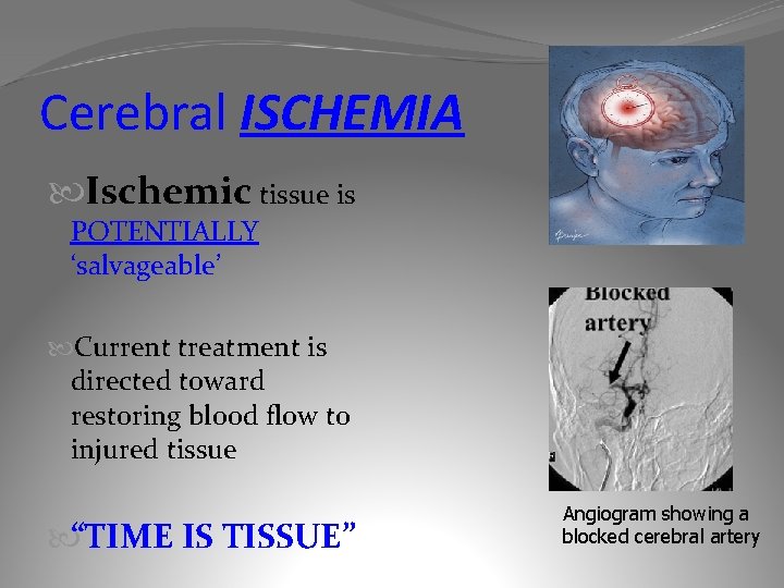 Cerebral ISCHEMIA Ischemic tissue is POTENTIALLY ‘salvageable’ Current treatment is directed toward restoring blood