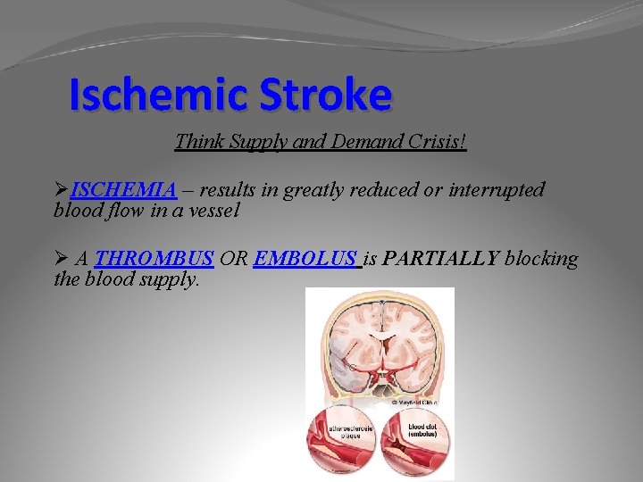 Ischemic Stroke Think Supply and Demand Crisis! ØISCHEMIA – results in greatly reduced or