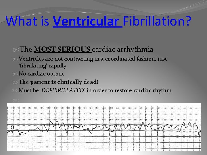 What is Ventricular Fibrillation? The MOST SERIOUS cardiac arrhythmia Ventricles are not contracting in