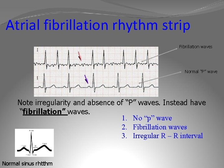 Atrial fibrillation rhythm strip Fibrillation waves Normal “P” wave Note irregularity and absence of