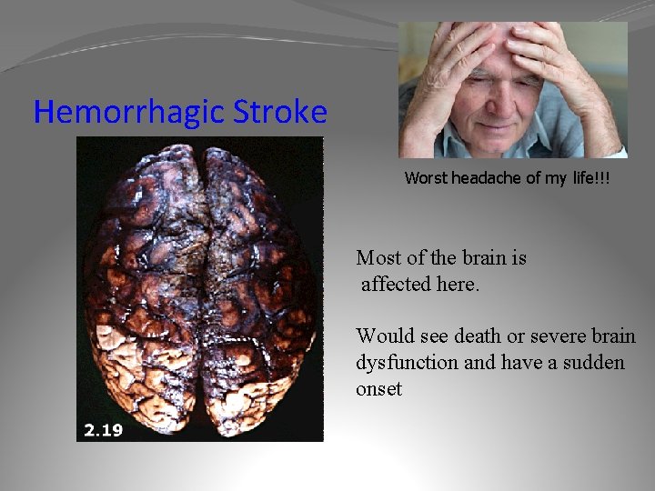 Hemorrhagic Stroke Worst headache of my life!!! Most of the brain is affected here.