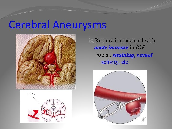 Cerebral Aneurysms ÏRupture is associated with acute increase in ICP Ïe. g. , straining,