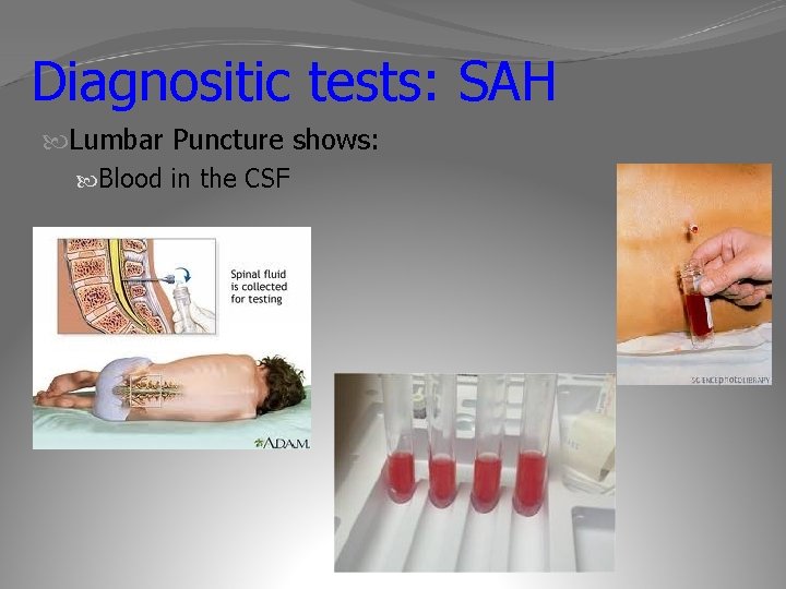 Diagnositic tests: SAH Lumbar Puncture shows: Blood in the CSF 