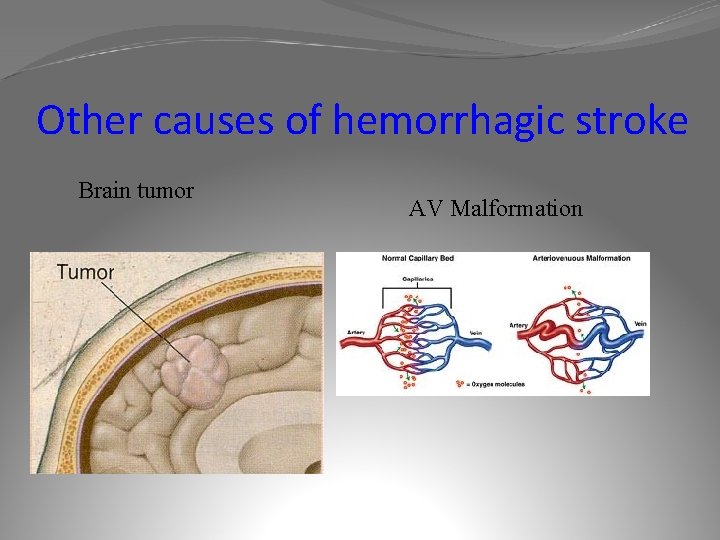 Other causes of hemorrhagic stroke Brain tumor AV Malformation 