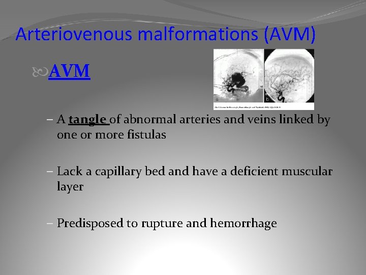 Arteriovenous malformations (AVM) AVM – A tangle of abnormal arteries and veins linked by