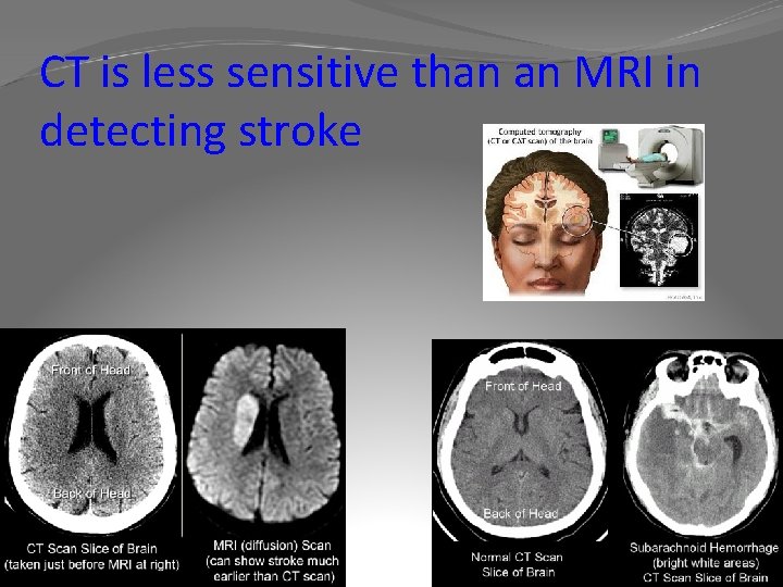 CT is less sensitive than an MRI in detecting stroke 