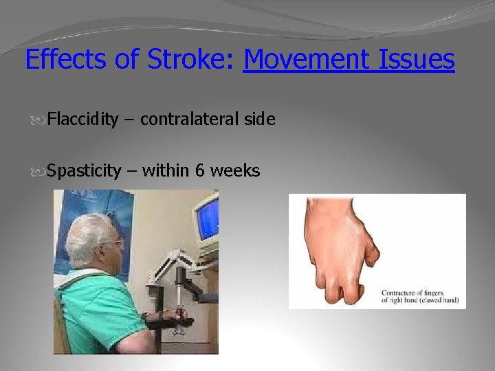 Effects of Stroke: Movement Issues Flaccidity – contralateral side Spasticity – within 6 weeks