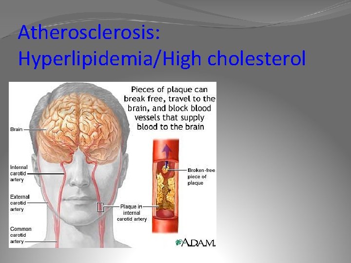 Atherosclerosis: Hyperlipidemia/High cholesterol 