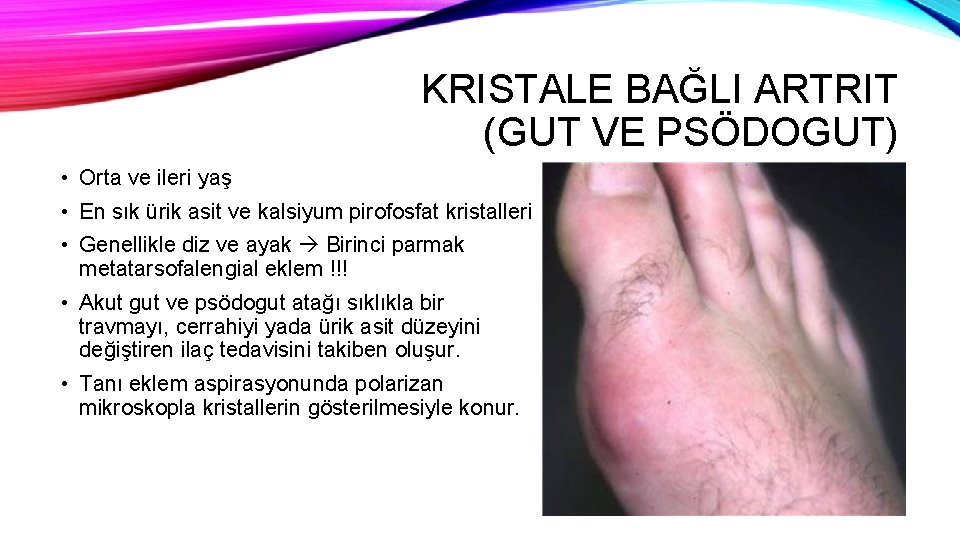 KRISTALE BAĞLI ARTRIT (GUT VE PSÖDOGUT) • Orta ve ileri yaş • En sık