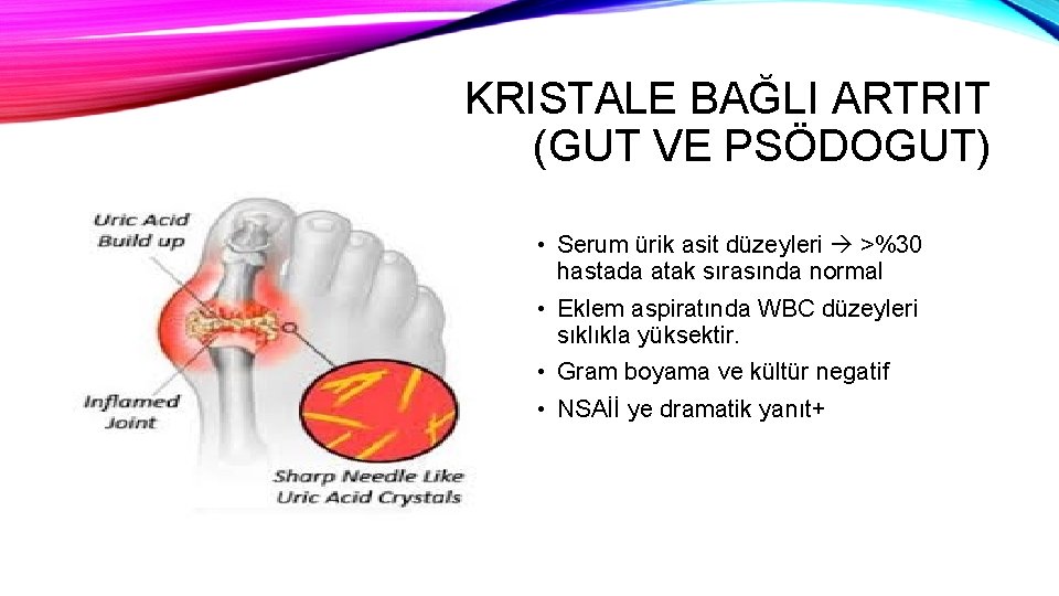 KRISTALE BAĞLI ARTRIT (GUT VE PSÖDOGUT) • Serum ürik asit düzeyleri >%30 hastada atak