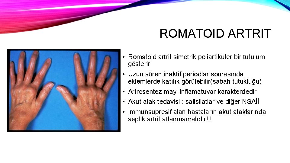 ROMATOID ARTRIT • Romatoid artrit simetrik poliartiküler bir tutulum gösterir • Uzun süren inaktif