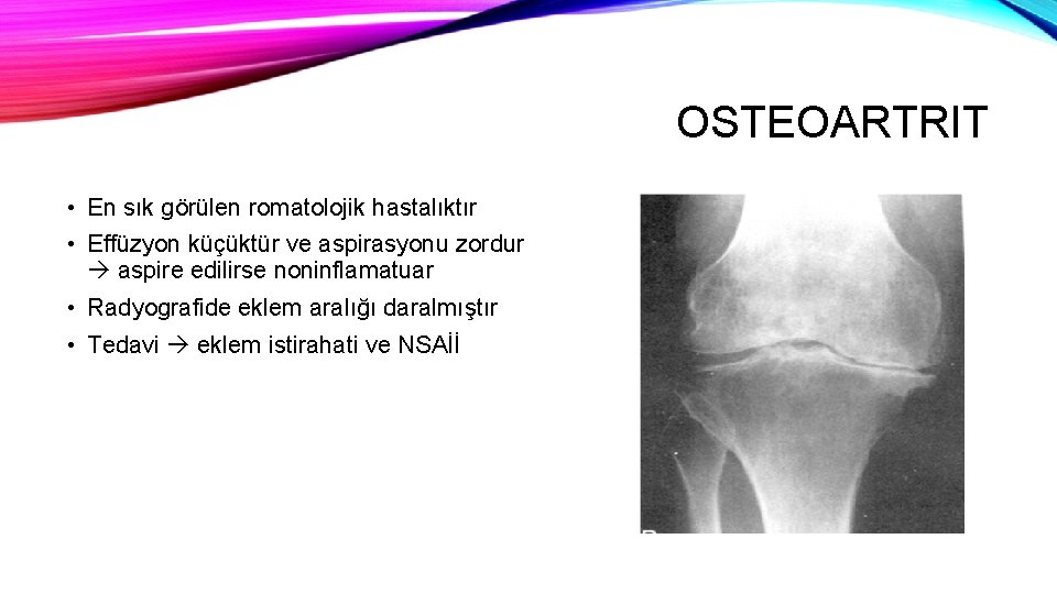 OSTEOARTRIT • En sık görülen romatolojik hastalıktır • Effüzyon küçüktür ve aspirasyonu zordur aspire