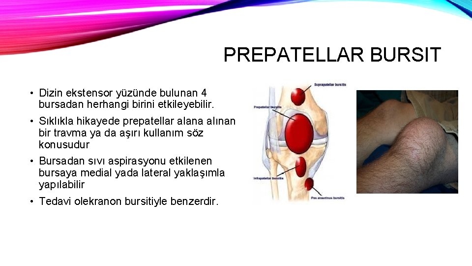 PREPATELLAR BURSIT • Dizin ekstensor yüzünde bulunan 4 bursadan herhangi birini etkileyebilir. • Sıklıkla