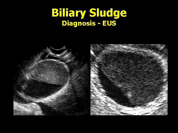 Biliary Sludge Diagnosis - EUS 