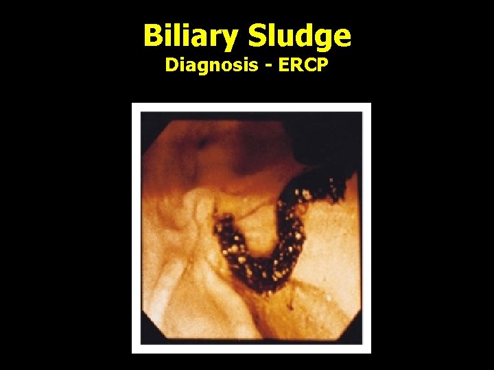 Biliary Sludge Diagnosis - ERCP 