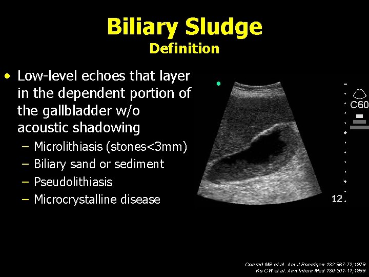 Biliary Sludge Definition • Low-level echoes that layer in the dependent portion of the