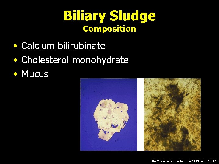 Biliary Sludge Composition • Calcium bilirubinate • Cholesterol monohydrate • Mucus Ko CW et