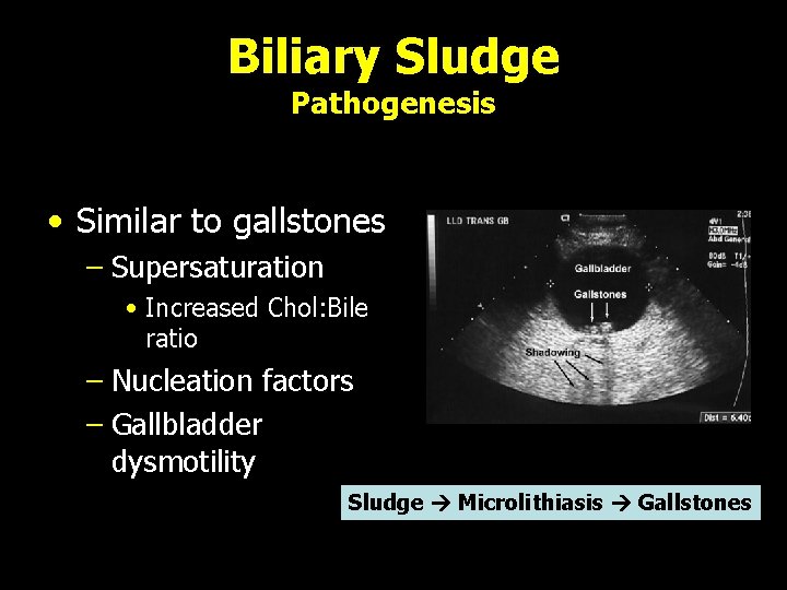 Biliary Sludge Pathogenesis • Similar to gallstones – Supersaturation • Increased Chol: Bile ratio