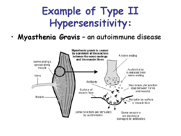 Example of Type II Hypersensitivity: • Myasthenia Gravis – an autoimmune disease 