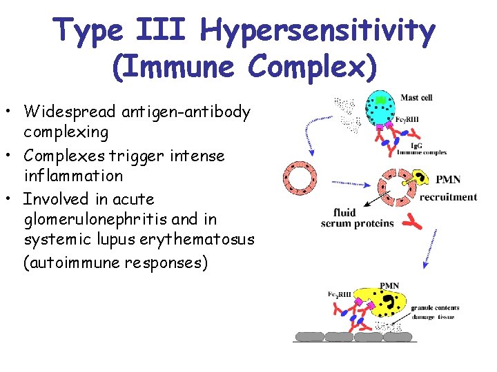Type III Hypersensitivity (Immune Complex) • Widespread antigen-antibody complexing • Complexes trigger intense inflammation