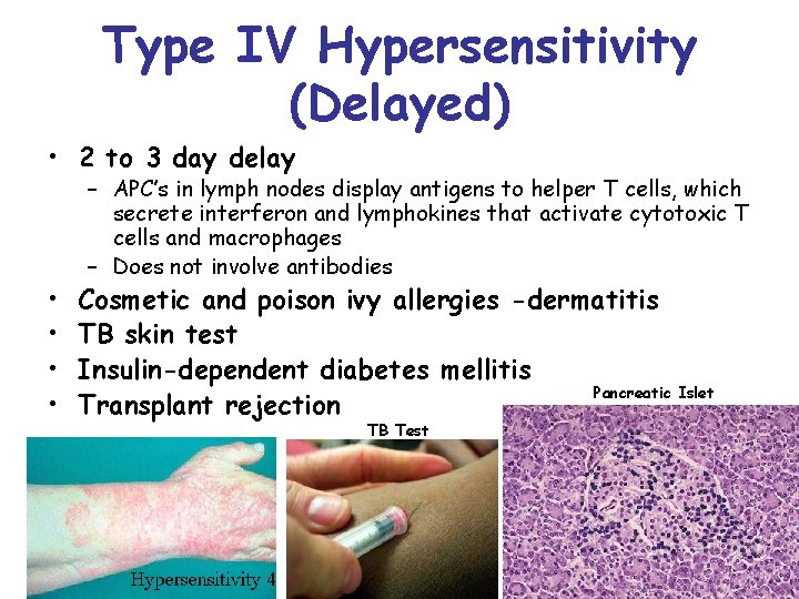 Type IV Hypersensitivity (Delayed) • 2 to 3 day delay • • – APC’s