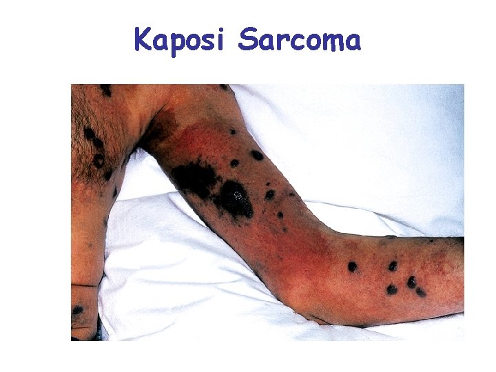 Kaposi Sarcoma 