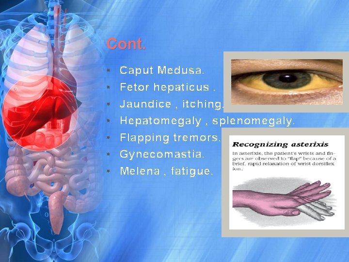 Cont. • • Caput Medusa. Fetor hepaticus. Jaundice , itching. Hepatomegaly , splenomegaly. Flapping