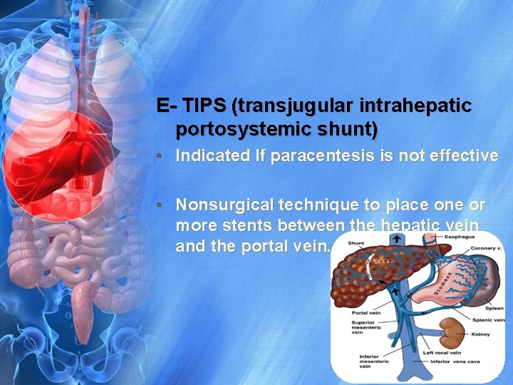 E- TIPS (transjugular intrahepatic portosystemic shunt) • Indicated If paracentesis is not effective •