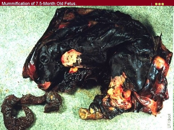 Mummification of 7. 5 -Month Old Fetus. 