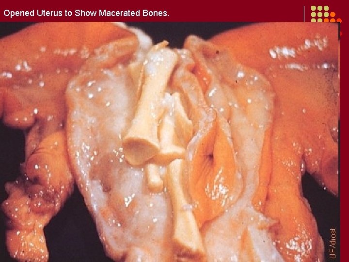 Opened Uterus to Show Macerated Bones. 