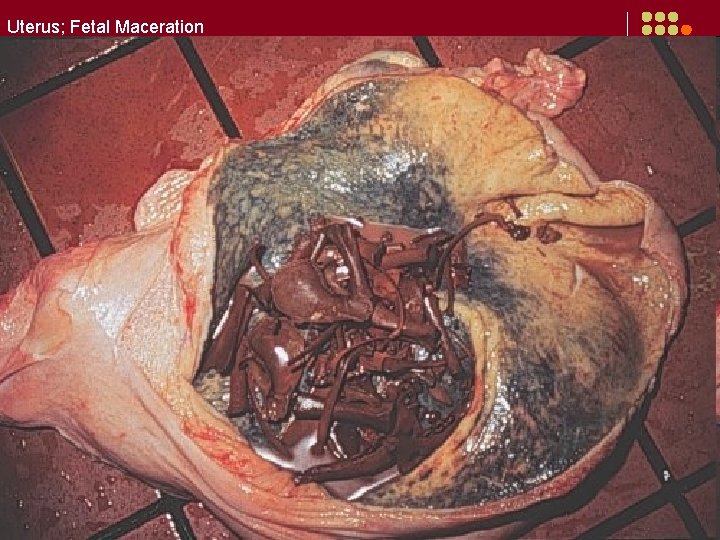 Uterus; Fetal Maceration 