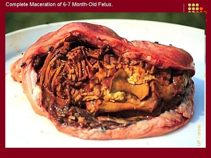 Complete Maceration of 6 -7 Month-Old Fetus. 