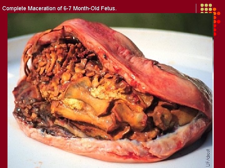 Complete Maceration of 6 -7 Month-Old Fetus. 