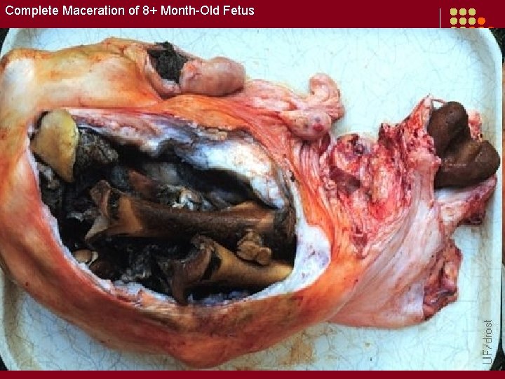 Complete Maceration of 8+ Month-Old Fetus 
