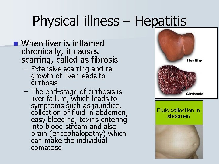 Physical illness – Hepatitis n When liver is inflamed chronically, it causes scarring, called