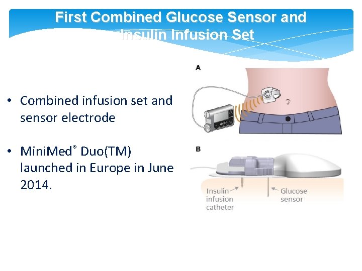 First Combined Glucose Sensor and Insulin Infusion Set • Combined infusion set and sensor