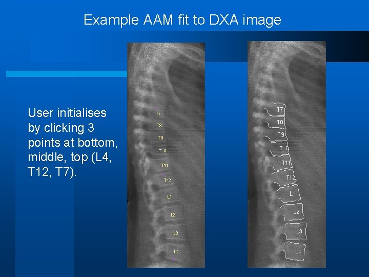 Example AAM fit to DXA image User initialises by clicking 3 points at bottom,