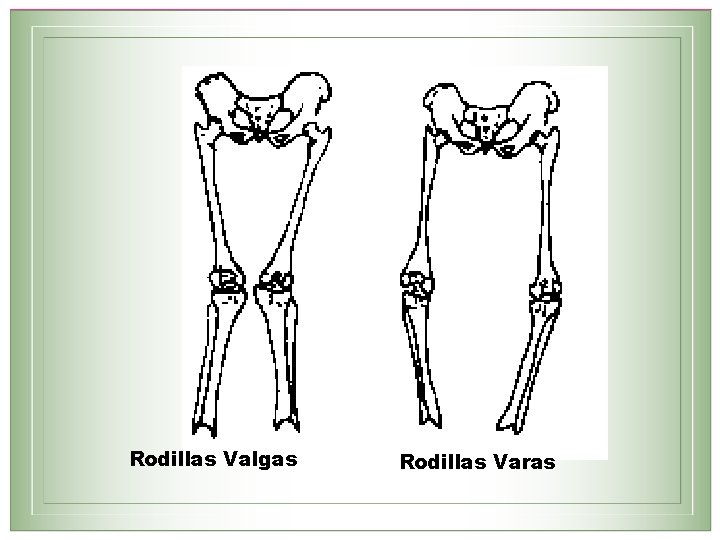 Rodillas Valgas Rodillas Varas 