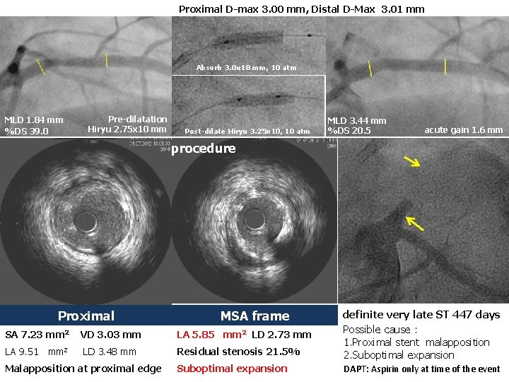 Proximal D-max 3. 00 mm, Distal D-Max 3. 01 mm Absorb 3. 0 x