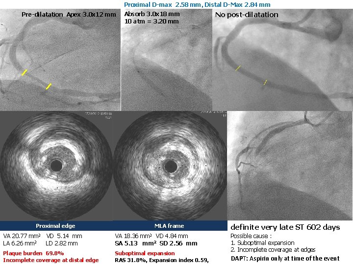 Proximal D-max 2. 58 mm, Distal D-Max 2. 84 mm Pre-dilatation Apex 3. 0