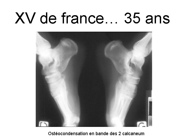 XV de france… 35 ans Ostéocondensation en bande des 2 calcaneum 